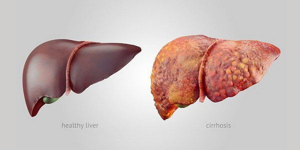 liver-cirrhosis