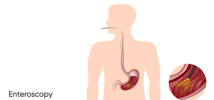 enteroscopy